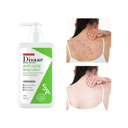 Disaar Salicylic Acid, Shea Butter & Ceramide Anti Acne Body Lotion 300g
