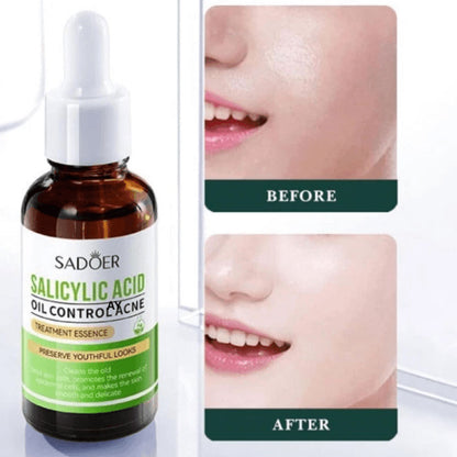 Sadoer Salicylic Acid Oil Control Acne Treatment Essence 30ml